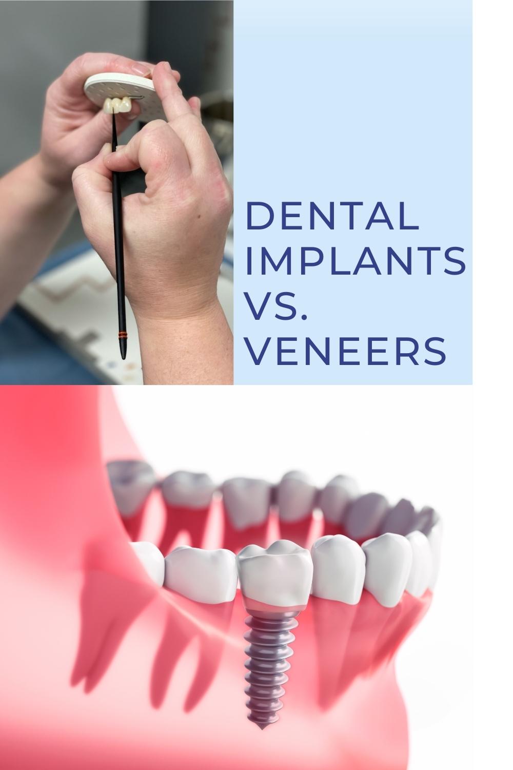 Implants vs. veneers