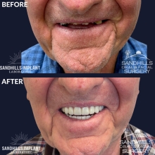 Before & After