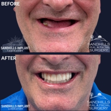 Before & After