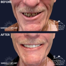 Before & After