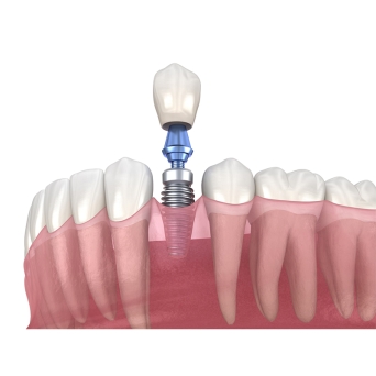 Dental Implant