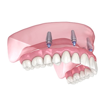 Full Arch Diagram