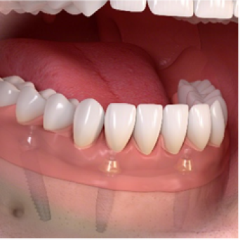 All Upper or Lower Teeth Replacement