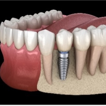 Implant Example