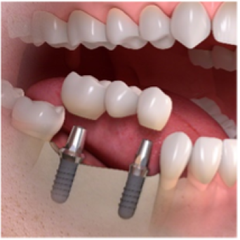 Multiple Tooth Implant