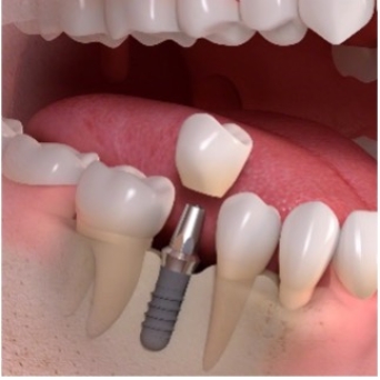 Single tooth implant