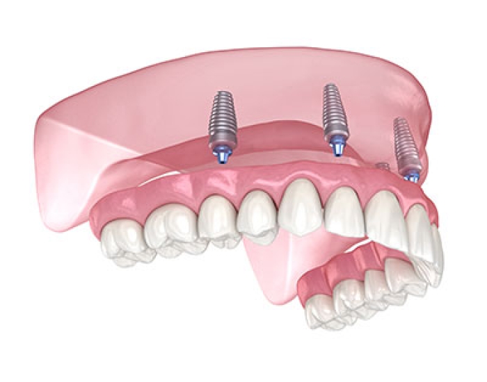 Full Arch Diagram