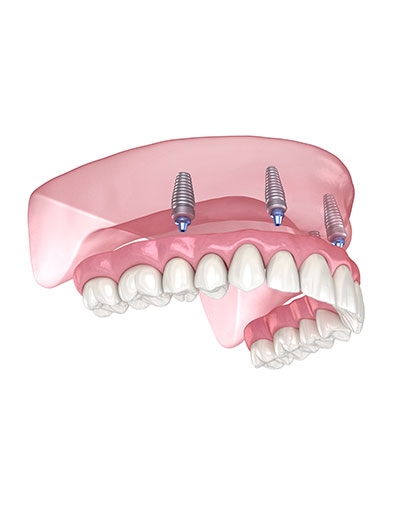 Full Arch Diagram