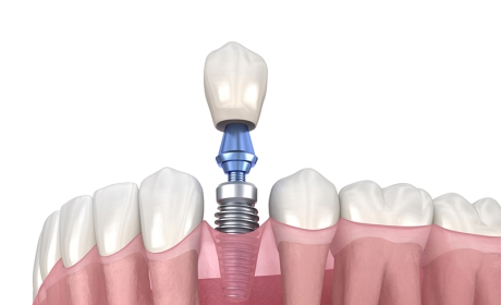 Dental Implant